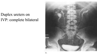 Duplex ureters on
IVP: complete bilateral
 