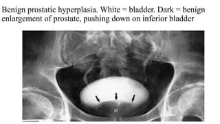 Benign prostatic hyperplasia. White = bladder. Dark = benign
enlargement of prostate, pushing down on inferior bladder
 