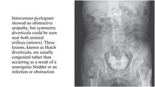 Intravenous pyelogram
showed no obstructive
uropathy, but symmetric
diverticula could be seen
near both ureteral
orifices (arrows). These
lesions, known as Hutch
diverticula, are usually
congenital rather than
occurring as a result of a
neurogenic bladder or an
infection or obstruction
 