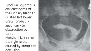 Nodular squamous
cell carcinoma of
the urinary bladder.
Dilated left lower
ureter probably
secondary to
obstruction by
tumor.
Nonvisualization of
the right ureter
caused by complete
 