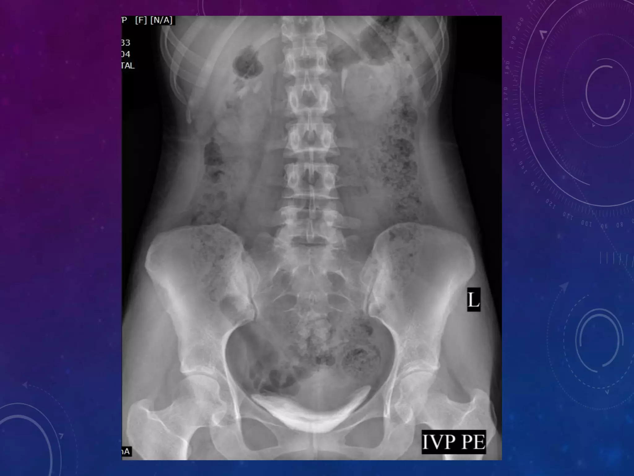 INTRAVENOUS UROGRAM (IVU) | PPTX
