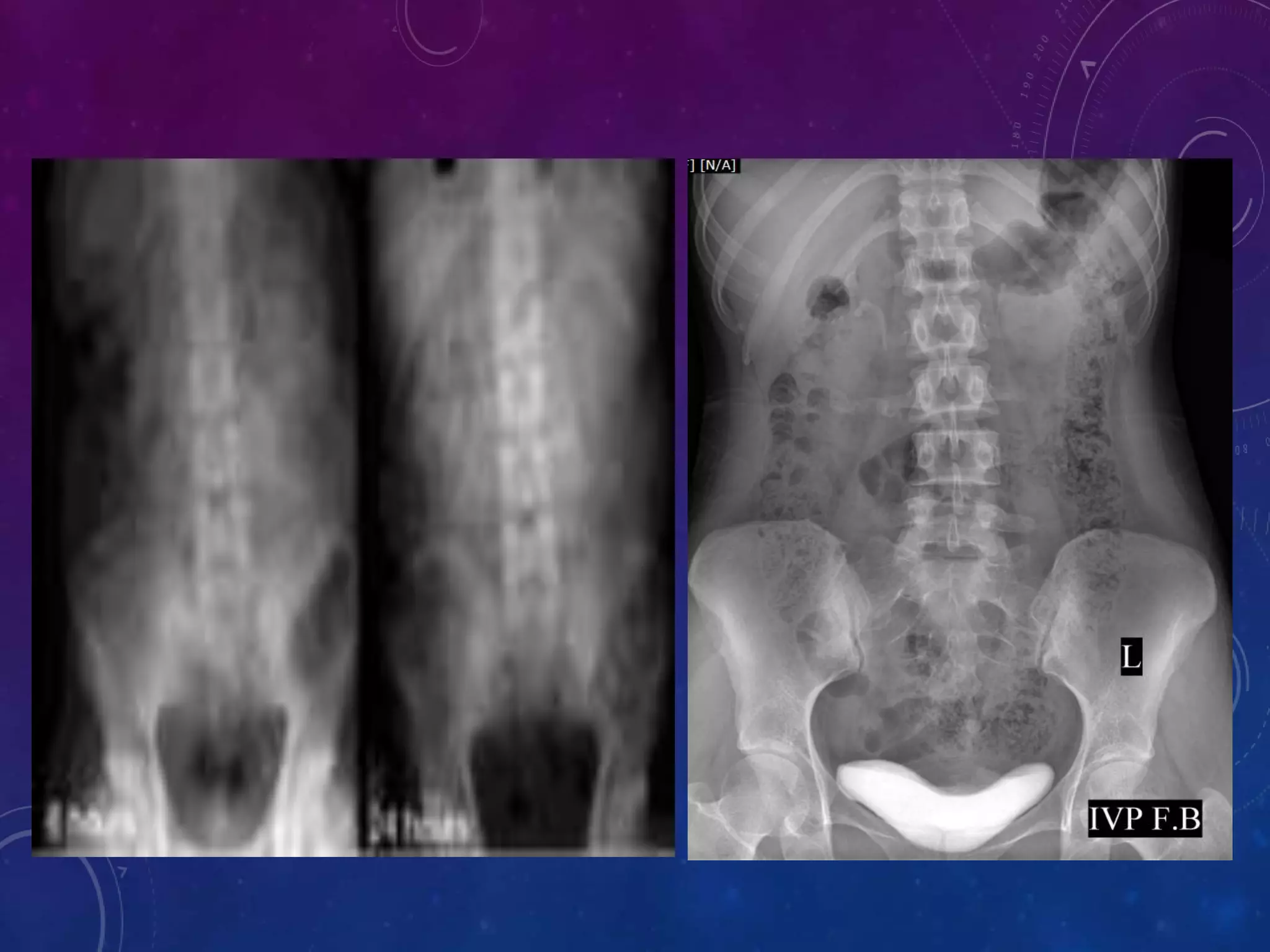 INTRAVENOUS UROGRAM (IVU) | PPTX