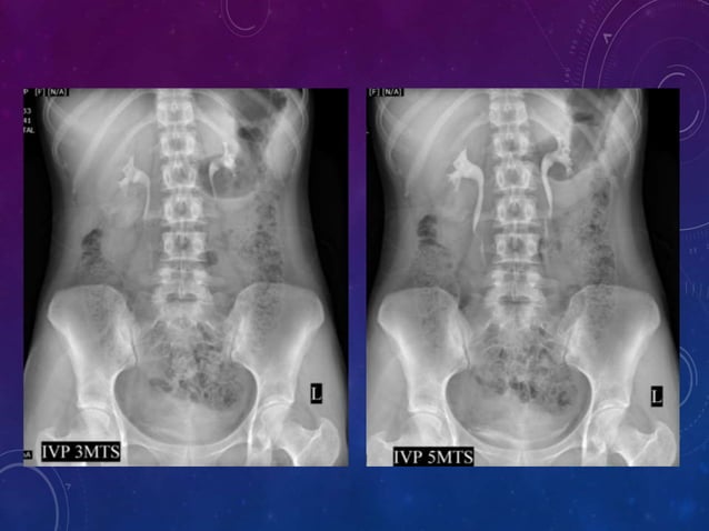 INTRAVENOUS UROGRAM (IVU) | PPTX