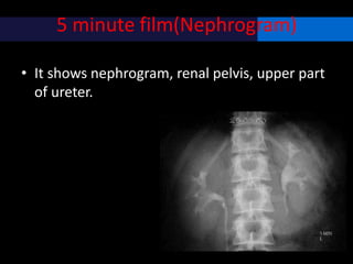 5 minute film(Nephrogram)
• It shows nephrogram, renal pelvis, upper part
of ureter.
 