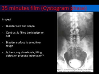 35 minutes film (Cystogram phase)
inspect :
- Bladder size and shape
- Contrast is filling the bladder or
not
- Bladder surface is smooth or
rough
- Is there any diverticlula, filling
defect or prostate indentation?
 