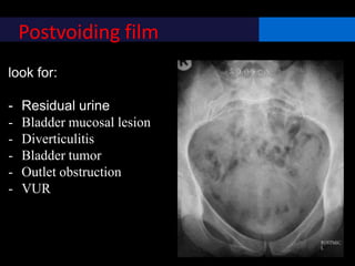 Postvoiding film
look for:
- Residual urine
- Bladder mucosal lesion
- Diverticulitis
- Bladder tumor
- Outlet obstruction
- VUR
 