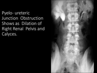 Pyelo- ureteric
Junction Obstruction
Shows as Dilation of
Right Renal Pelvis and
Calyces.
 