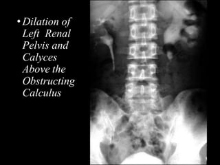 •Dilation of
Left Renal
Pelvis and
Calyces
Above the
Obstructing
Calculus
 