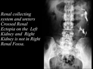 Renal collecting
system and ureters
Crossed Renal
Ectopia on the Left
Kidney and Right
Kidney is not in Right
Renal Fossa.
 