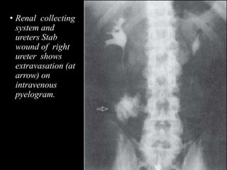 • Renal collecting
system and
ureters Stab
wound of right
ureter shows
extravasation (at
arrow) on
intravenous
pyelogram.
 