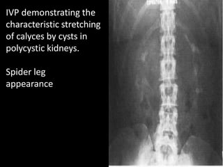 IVP demonstrating the
characteristic stretching
of calyces by cysts in
polycystic kidneys.
Spider leg
appearance
 