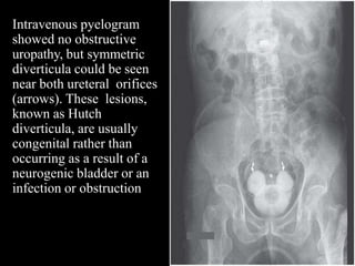 Intravenous pyelogram
showed no obstructive
uropathy, but symmetric
diverticula could be seen
near both ureteral orifices
(arrows). These lesions,
known as Hutch
diverticula, are usually
congenital rather than
occurring as a result of a
neurogenic bladder or an
infection or obstruction
 