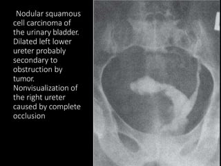 Nodular squamous
cell carcinoma of
the urinary bladder.
Dilated left lower
ureter probably
secondary to
obstruction by
tumor.
Nonvisualization of
the right ureter
caused by complete
occlusion
 