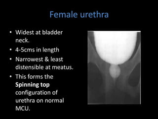 Female urethra
• Widest at bladder
neck.
• 4-5cms in length
• Narrowest & least
distensible at meatus.
• This forms the
Spinning top
configuration of
urethra on normal
MCU.
 