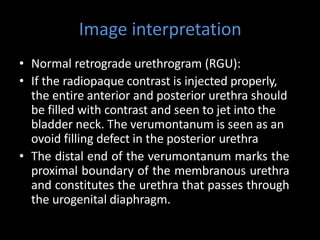 Image interpretation
• Normal retrograde urethrogram (RGU):
• If the radiopaque contrast is injected properly,
the entire anterior and posterior urethra should
be filled with contrast and seen to jet into the
bladder neck. The verumontanum is seen as an
ovoid filling defect in the posterior urethra
• The distal end of the verumontanum marks the
proximal boundary of the membranous urethra
and constitutes the urethra that passes through
the urogenital diaphragm.
 