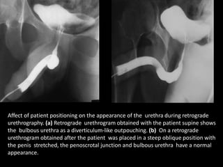 Affect of patient positioning on the appearance of the urethra during retrograde
urethrography. (a) Retrograde urethrogram obtained with the patient supine shows
the bulbous urethra as a diverticulum-like outpouching. (b) On a retrograde
urethrogram obtained after the patient was placed in a steep oblique position with
the penis stretched, the penoscrotal junction and bulbous urethra have a normal
appearance.
 