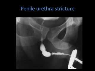 Penile urethra stricture
 