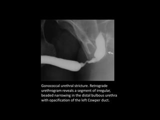 Gonococcal urethral stricture. Retrograde
urethrogram reveals a segment of irregular,
beaded narrowing in the distal bulbous urethra
with opacification of the left Cowper duct.
 