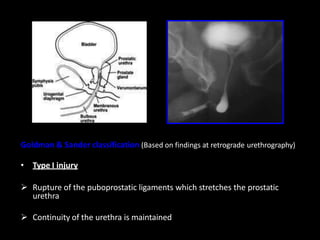 Goldman & Sander classification (Based on findings at retrograde urethrography)
• Type I injury
 Rupture of the puboprostatic ligaments which stretches the prostatic
urethra
 Continuity of the urethra is maintained
 