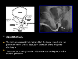  Type III injury (MC)
The membranous urethra is ruptured but the injury extends into the
proximal bulbous urethra because of laceration of the urogenital
diaphragm
Extravasation not only into the pelvic extraperitoneal space but also
into the perineum.
 