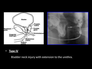 • Type IV
Bladder neck injury with extension to the urethra.
 