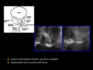 Type V injury
Injury to the Anterior urethra - partial or complete.
Extravasation seen to penile soft tissue.
 