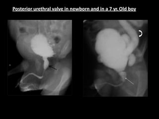 Posterior urethral valve in newborn and in a 7 yr. Old boy
 