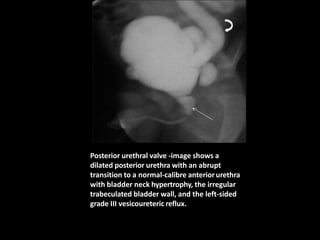 Posterior urethral valve -image shows a
dilated posterior urethra with an abrupt
transition to a normal-calibre anteriorurethra
with bladder neck hypertrophy, the irregular
trabeculated bladder wall, and the left-sided
grade III vesicoureteric reflux.
 