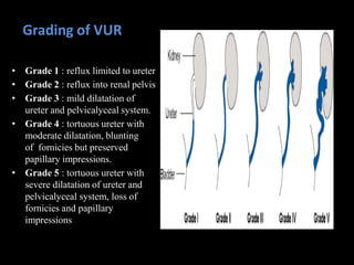 Grading of VUR
• Grade 1 : reflux limited to ureter
• Grade 2 : reflux into renal pelvis
• Grade 3 : mild dilatation of
ureter and pelvicalyceal system.
• Grade 4 : tortuous ureter with
moderate dilatation, blunting
of fornicies but preserved
papillary impressions.
• Grade 5 : tortuous ureter with
severe dilatation of ureter and
pelvicalyceal system, loss of
fornicies and papillary
impressions
 