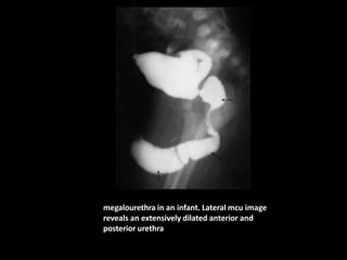 megalourethra in an infant. Lateral mcu image
reveals an extensively dilated anterior and
posterior urethra
 