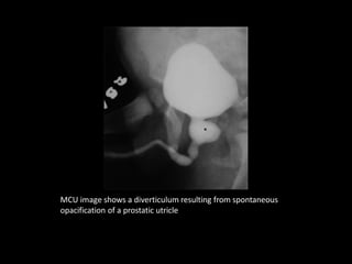 MCU image shows a diverticulum resulting from spontaneous
opacification of a prostatic utricle
 