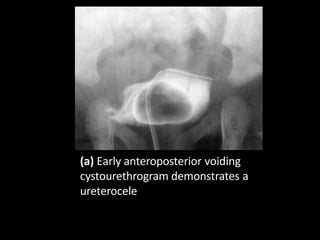 (a) Early anteroposterior voiding
cystourethrogram demonstrates a
ureterocele
 