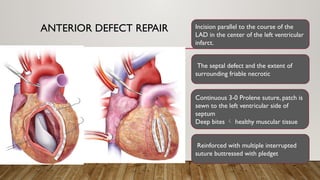 ANTERIOR DEFECT REPAIR Incision parallel to the course of the
LAD in the center of the left ventricular
infarct.
The septal defect and the extent of
surrounding friable necrotic
Continuous 3-0 Prolene suture, patch is
sewn to the left ventricular side of
septum
Deep bites  healthy muscular tissue
Reinforced with multiple interrupted
suture buttressed with pledget
 