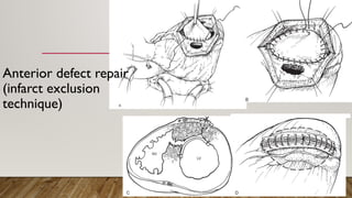 Anterior defect repair
(infarct exclusion
technique)
 