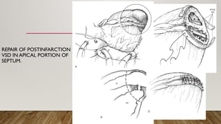 REPAIR OF POSTINFARCTION
VSD IN APICAL PORTION OF
SEPTUM.
 