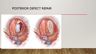 POSTERIOR DEFECT REPAIR
 