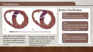 Classification
Single defect with through-and-
through communication across
the septum, usually associated
with anterior MI and located in
the apex
Extensive hemorrhage with irregular
serpiginious borders of the necrotic
muscle, usually occur in inferior
infracts and involve the basal
inferioposterior septum
 