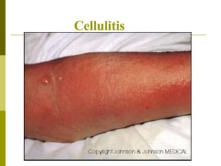 Cellulitis
 