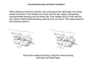 CONTINUOUS INFUSION: SECURING THE NEEDLE
When starting a continuous infusion, you must secure the right-angle, non-coring
needle to the skin. If the needle hub is flush with the skin, apply a transparent
semipermeable dressing over the entire site. If the needle hub isn’t flush with the
skin, place a folded sterile dressing under the hub, as shown. Then apply adhesive
skin closures across it.
Secure the needle and tubing, using the chevron-taping
technique with sterile tape.
 
