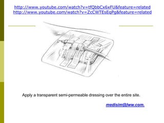 Apply a transparent semi-permeable dressing over the entire site.
medisim@lww.com.
http://www.youtube.com/watch?v=tfQbbCx6xFU&feature=related
http://www.youtube.com/watch?v=ZcCWTEsEqPg&feature=related
 