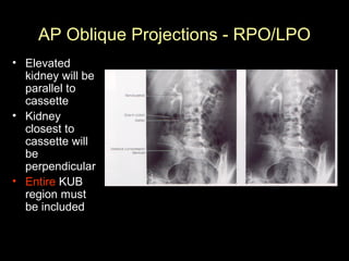 AP Oblique Projections - RPO/LPO
• Elevated
kidney will be
parallel to
cassette
• Kidney
closest to
cassette will
be
perpendicular
• Entire KUB
region must
be included

 