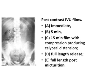 Post contrast IVU films.
• (A) Immediate,
• (B) 5 min,
• (C) 15 min film with
compression producing
calyceal distension;
• (D) full length release;
• (E) full length post
micturition.
 