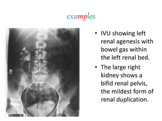 examples
• IVU showing left
renal agenesis with
bowel gas within
the left renal bed.
• The large right
kidney shows a
bifid renal pelvis,
the mildest form of
renal duplication.
 