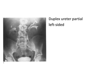 Duplex ureter partial
left-sided
 