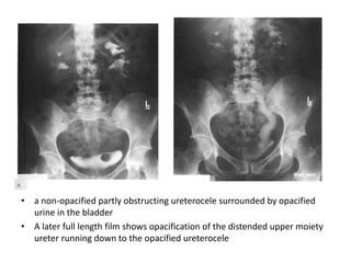 • a non-opacified partly obstructing ureterocele surrounded by opacified
urine in the bladder
• A later full length film shows opacification of the distended upper moiety
ureter running down to the opacified ureterocele
 
