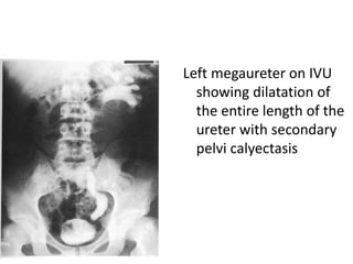 Left megaureter on IVU
showing dilatation of
the entire length of the
ureter with secondary
pelvi calyectasis
 