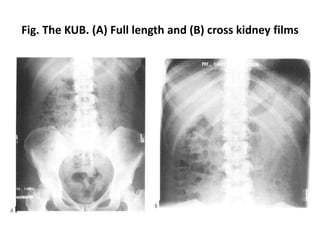Fig. The KUB. (A) Full length and (B) cross kidney films
 