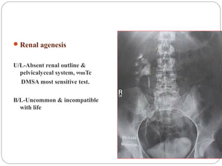 Renal agenesis
U/L-Absent renal outline &
pelvicalyceal system, 99mTc
DMSA most sensitive test.
B/L-Uncommon & incompatible
with life
 