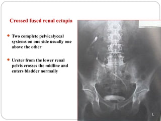 Crossed fused renal ectopia
 Two complete pelvicalyceal
systems on one side usually one
above the other
 Ureter from the lower renal
pelvis crosses the midline and
enters bladder normally
 
