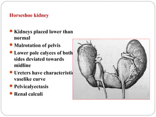 Horseshoe kidney
Kidneys placed lower than
normal
Malrotation of pelvis
Lower pole calyces of both
sides deviated towards
midline
Ureters have characteristic
vaselike curve
Pelvicalyectasis
Renal calculi
 
